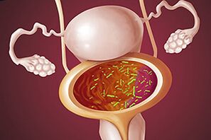 Cistitis bacteriana en una mujer.