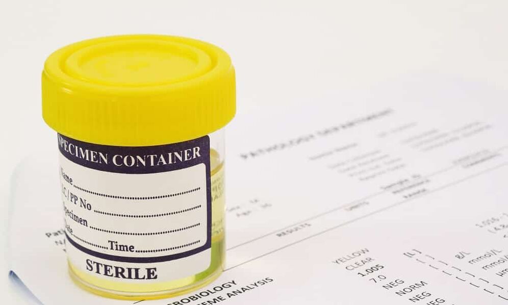 Debe hacerse un análisis de orina antes de tomar antibióticos.