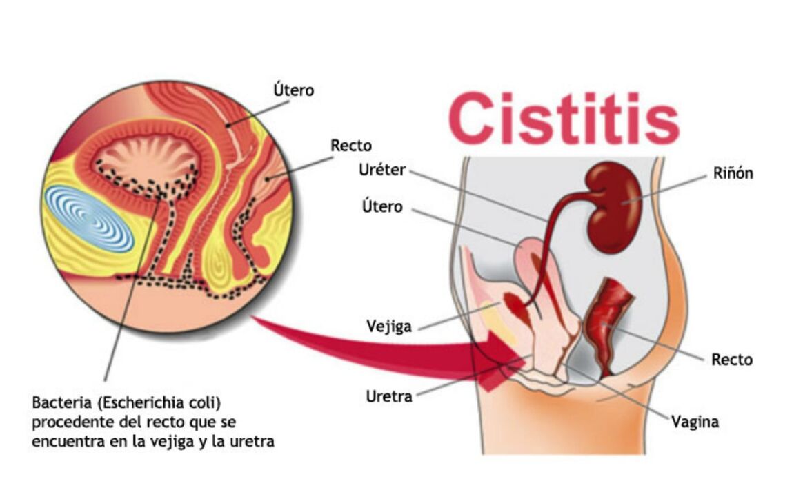 E. coli es una de las causas de cistitis en las mujeres.