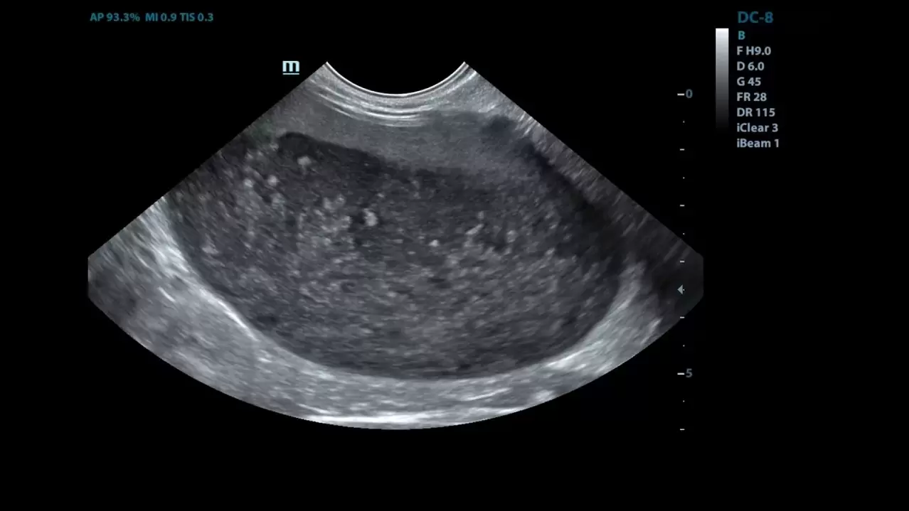 cistitis en mis imágenes de ultrasonido antes del uso de Cystolax